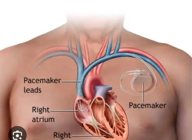 Pacemaker
